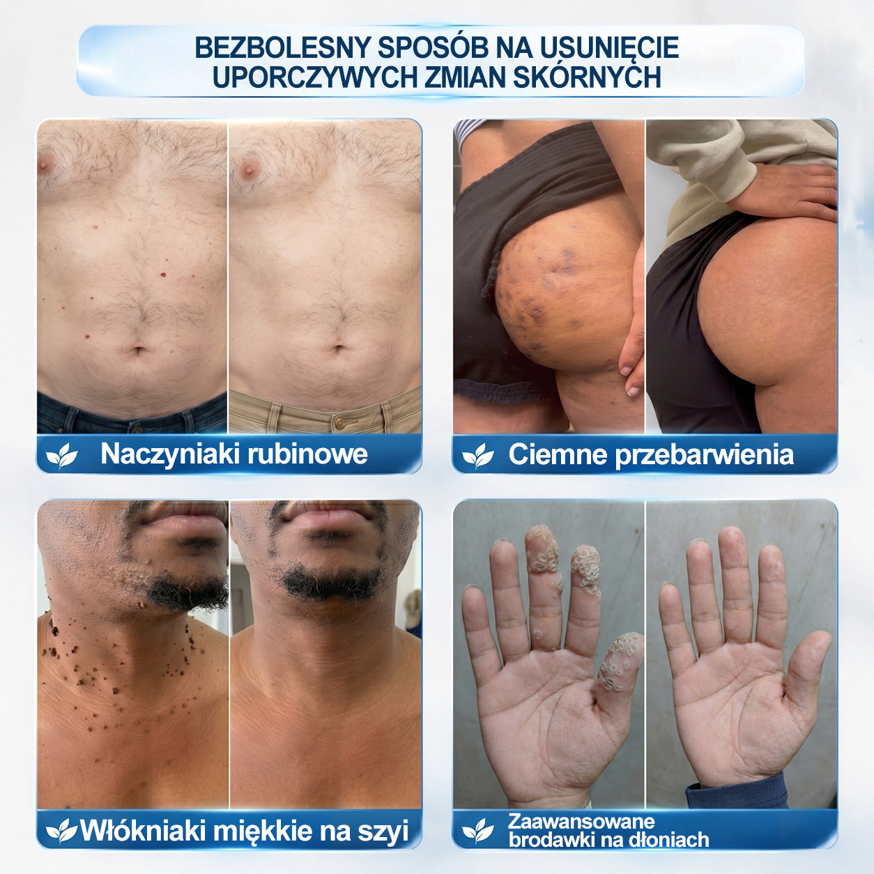 Oficjalny sklep markowy |☀️Hiskin® 7 𝑫𝒏𝒊 𝑷𝒓𝒆𝒑𝒂𝒓𝒂𝒕 𝑫𝒐 𝑼𝒔𝒖𝒘𝒂𝒏𝒊𝒂 𝑾łó𝒌𝒏𝒊𝒂𝒌ó𝒘 𝑴𝒊ę𝒌𝒌𝒊𝒄𝒉 𝑰 𝑷𝒓𝒛𝒆𝒃𝒂𝒓𝒘𝒊𝒆ń(𝐁𝐞𝐳 𝐁ó𝐥𝐮, 𝐁𝐞𝐳 𝐁𝐥𝐢𝐳𝐧 – 𝐑𝐨𝐥𝐥-𝐨𝐧)