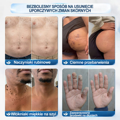 Oficjalny sklep markowy |☀️Hiskin® 7 𝑫𝒏𝒊 𝑷𝒓𝒆𝒑𝒂𝒓𝒂𝒕 𝑫𝒐 𝑼𝒔𝒖𝒘𝒂𝒏𝒊𝒂 𝑾łó𝒌𝒏𝒊𝒂𝒌ó𝒘 𝑴𝒊ę𝒌𝒌𝒊𝒄𝒉 𝑰 𝑷𝒓𝒛𝒆𝒃𝒂𝒓𝒘𝒊𝒆ń(𝐁𝐞𝐳 𝐁ó𝐥𝐮, 𝐁𝐞𝐳 𝐁𝐥𝐢𝐳𝐧 – 𝐑𝐨𝐥𝐥-𝐨𝐧)